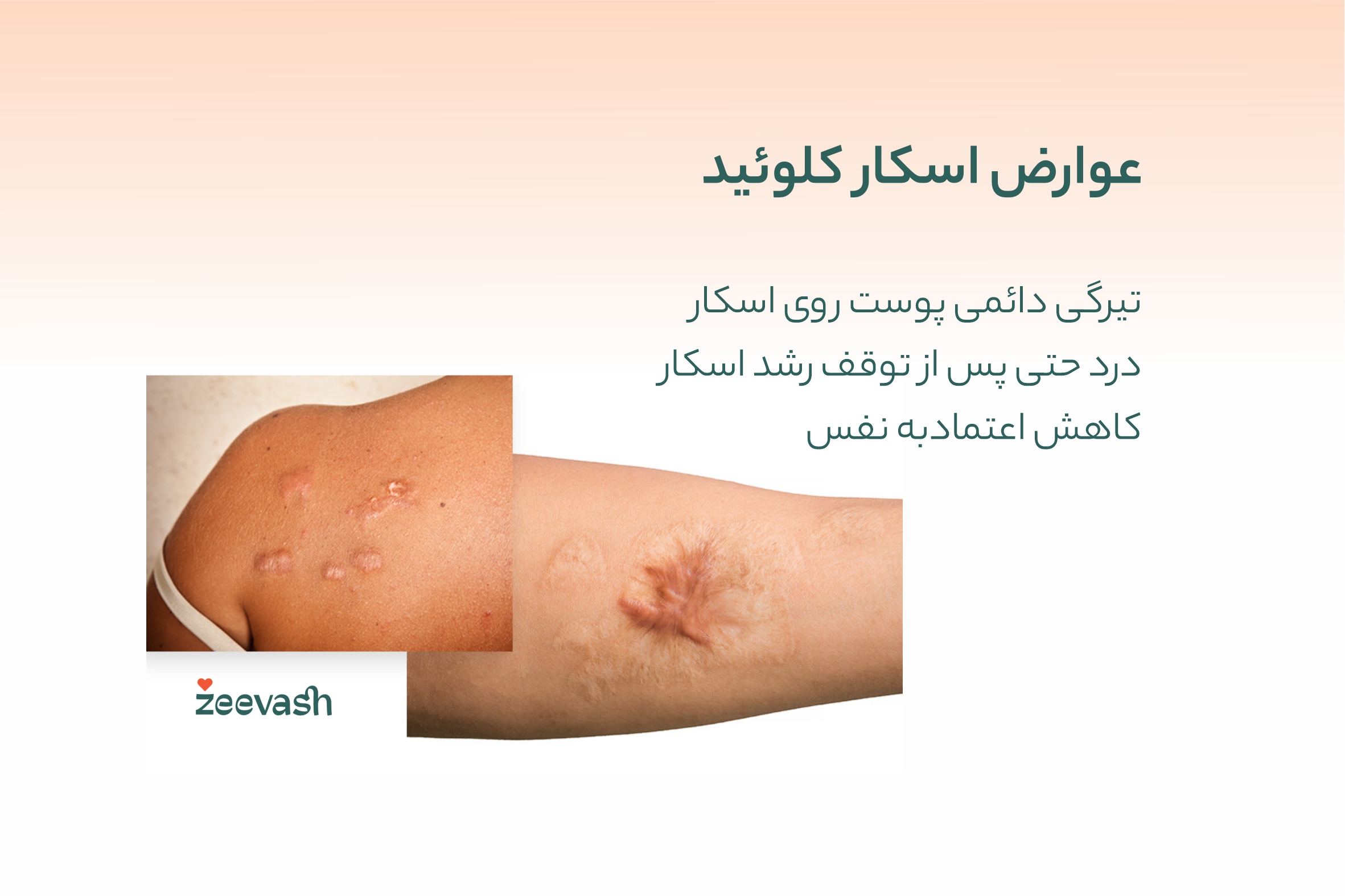 عوارض اسکار کلوئید